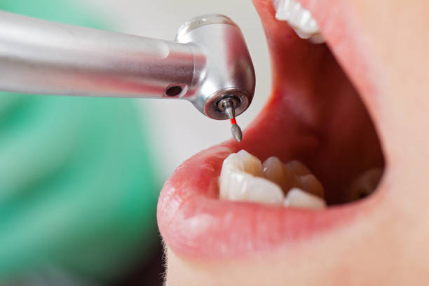 Best Emergency Dental Extractions in Pinehurst, MA